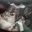 윤현실산부인과의원 | [난임기록]동결4차 종결