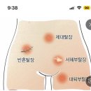 여기에 뾰루지났는데 안없어져 산부인과에서도 째주나..? 이미지