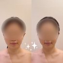 W_8. 광주 윤곽관리 전문 리큐브에스테틱에서 예신 웨딩관리 받기👰