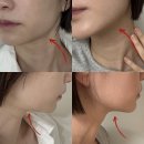 누가메디칼 | 신사역성형외과 울쎄라 비올 듀오타이트 내돈내산 솔직후기, 통증, 가격