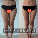 수백 | 일본 마운자로에서 허벅지 지방흡입까지, 다이어트에 수백 쓰고 정착한 솔직 후기