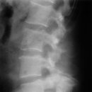 2. 척추분리증(spondylolysis)과 척추전방전위증(spondylolisthesis) 이미지