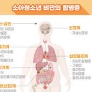 소아비만 나이 기준 원인 식단 이미지