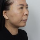 플레인의원 | 부산안면거상 50대 분들이 찾으시는 후기 및 흉터에 대하여