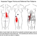 psoas major (대요근 )과 장골근(iliacus) 이미지