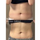 광주 | 광주다이어트 솔직후기｜복부다이어트주사 &amp; 팔뚝 제로팻 효과 변화