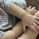 성균관유치원 | 창원 삼성병원에서 6세 유아 편도 아데노이드 제거 후기