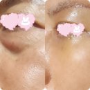 연세강연웅성형외과의원 | 광고절대X 내돈내산) 3년ㅠ알아보고 결정한 눈밑지방재배치+상안검+하안검 수술❣️대성공❣️