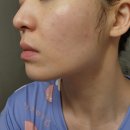 시네마의원 | 논현동 시네마의원 리쥬란힐러4cc 💉💉내돈내산 솔직후기