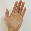 수포차 | 손가락 수포 습진 가려움 손가락 껍질 벗겨짐 관리 후기