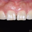 미소채움치과의원 | 수원치과 앞니 벌어짐 레진치료, 비용, 후기, 수명