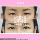 바이준성형외과의원 | 눈썹하거상 수술 전후, 인상 변화 없이 처진 눈만 자연스럽게 (바이미 최한뫼 원장)