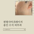 용인피부과 편평사마귀레이저 :: 비용, 일주일 후기