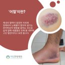 봉동한의원 | 정읍 교통사고 입원 치료 찾으시나요? | 해빛한방병원