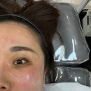 진동우리치과의원 | 디캐럿의원 쥬베룩볼륨 리쥬란아이 스킨보톡스 내돈내산 1차 다크서클 개선 후기