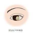 진균성 각막 궤양[Fungal corneal ulcers]눈질환 이미지