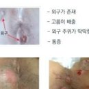 항문 농양 증상 및 원인과 수술 이미지