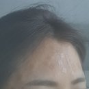 진의원 | 하단 청담진의원 비립종 , 사마귀 제거 후기
