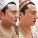 웨이브필 | 울산 웨딩관리 윤곽 리프팅 2회차 노진희피부연구소 웨이브온다