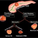 췌장물혹[Pancreatic cyst] 이미지