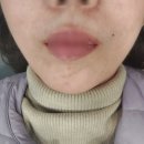 압구정성형외과 볼륨콜라겐 팔자 쥬베룩볼륨 내돈내산 후기/ 압구정쥬베룩볼륨
