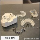 교정 유지 장치 치과 주걱턱 치아 전에 턱부터