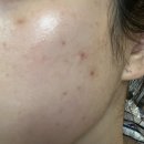 예쁨주의쁨의원 | 스킨부스터 필로드 통증 얼마나? 강남역 예쁨주의쁨의원 본점 솔직후기 (2cc 용량, 주사자국 경과)✨