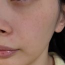 진비뇨기과의원 | 선릉 힐비뇨기과 잡티제거 후기, 결혼 전 피부관리와 1주일 후기