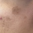 삼일의원 | [예수의원] 검버섯 제거 만족 후기 내돈내산 찐후기