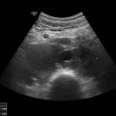 R/O retroperitoneal fibrosis 이미지