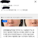비케이파트너스 | 쥬베룩볼륨 2cc 팔자주름 후기