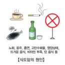 식도암 (Esophageal Cancer) 이미지