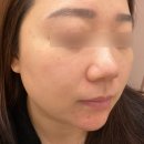 블리비의원 | [뷰티] 제주노형 블리비의원 내돈내산 편평사마귀 제거 후기