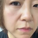 어메이징홈케어 | 온슬로 레티날 팔자주름패치로 시작한 간편한 팔자주름 홈케어 후기