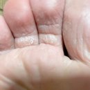 모두약국 | 바르지오모두크림 사용한 약국 무좀약 최종 후기