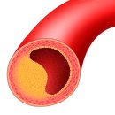 제일속시원내과의원 | 이 질환이 있다면, 사직역내과 경동맥초음파!