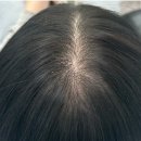 머리에반하다 | [머리에 반하다 화곡점] 여성 가르마 탈모, 4가닥 헤어증모술 후기