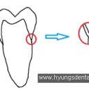 치과에서 크라운으로 씌운 치아에서 충치가 다시 생기는 이유 이미지