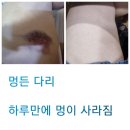 하루에 멍 이미지