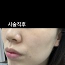 구래동 피부관리 초이스뷰티 모공관리 | 콜드플라즈마 물방울리프팅 후기