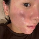 폼메디칼 | [(신사&amp;압구정) 메디컬오 한의원] 모공주사 11회차 + 포텐자 내돈내산 후기