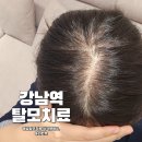 머리나라헤어라인 | 강남역 여성 탈모치료 메조테라피 및 M자탈모 헤어라인 머리 심기 상담 후기