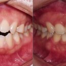 혜원치과의원 | 4월달의 교정 후기 감사합니다🧡