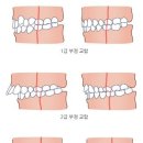 치료가 필요한 부정교합 종류 이미지