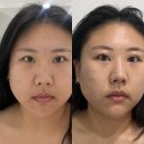 건강을플러스하다 | 천안 피부관리 이중턱 고민 비스킨랩 리프팅으로 해결