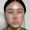 된 날 .. 기미와 주근깨를 루비레이저 970방으로 박멸하고 온 당일 후기(주차, 통증, 가격) : 루나의원