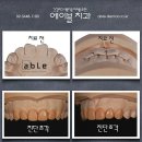 에이블치과기공소 네이버블로그