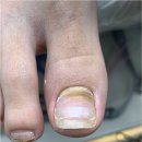 동성메디칼 | 안양 범계 발톱무좀 미엘네일 동성제약 풀리메디 범계점 강력 추천