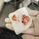 윈치과병원 | 군포 산본 윈치과에서 매복사랑니 뽑은 후기