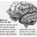 뇌졸증과 뇌출혈의 주요증상 이미지